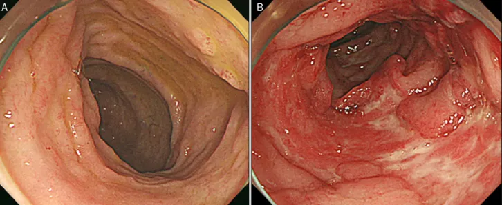 Fig. 1. Colonoscopic finding. (A) In the terminal ileum, diffuse hyperemic mucosa with a few tiny erosions was noted