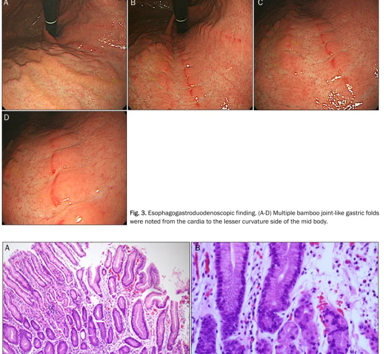 Fig. 3. Esophagogastroduodenoscopic finding. (A-D) Multiple bamboo joint-like gastric folds were noted from the cardia to the lesser curvature side of the mid body.