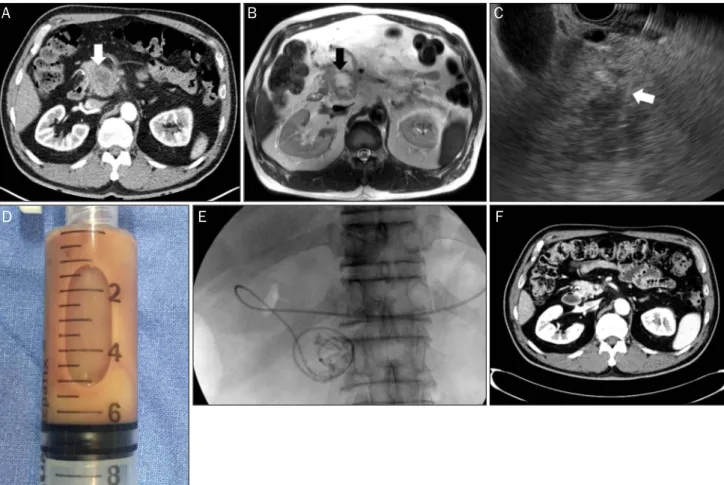 Fig. 1. (A) Transverse abdominal CT scans shows an ill-defined low attenuating mass (white arrow) along the pancreatic head