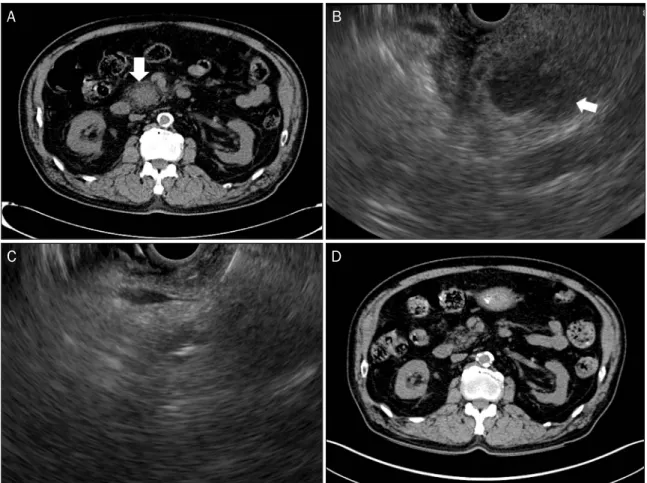 Fig. 2. (A) Non-contrast enhanced abdominal CT showing an exophytic mass in the uncinate process of the pancreas