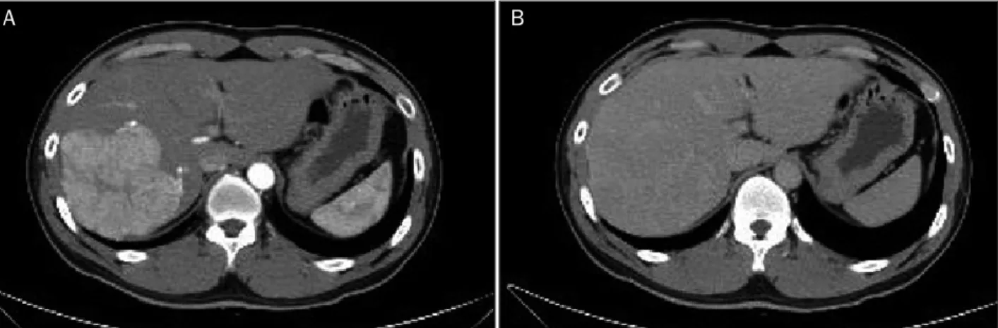 Fig. 1. Liver dynamic CT showed a enhancing mass with a size of 10.4 cm at right lobe