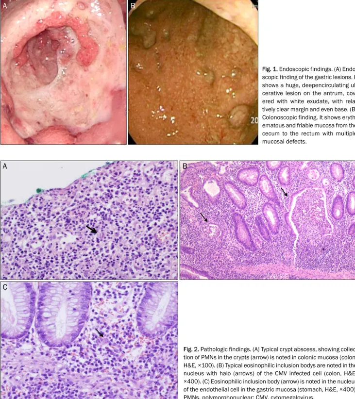 Fig. 1. Endoscopic findings. (A) Endo-  scopic finding of the gastric lesions. It  shows a huge, deepencirculating  ul-cerative lesion on the antrum,  cov-ered with white exudate, with  rela-tively clear margin and even base
