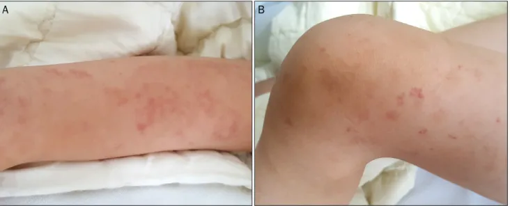 Fig. 4. Patient’s skin lesion. Various forms of skin purpura are observed at (A) the arm, and (B) the knee.