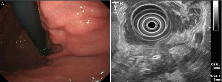 Fig. 1. Initial endoscopy and endosonography. (A) Endoscopy shows a subepithelial lesion with a small, deep ulceration in its center at the posteri- posteri-or wall of the upper body of the stomach