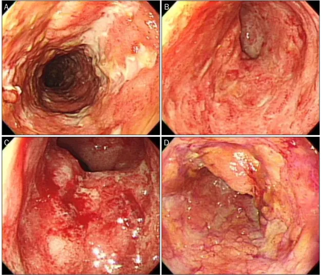Fig. 1. Multiple longitudinal and geographic ulcerations with some denuded colonic mucosa and easy touch bleeding were noted from the distal descending colon to the rectum