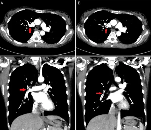 Fig. 2. Chest dynamic computed tomography showed a filling defect in the lobar and segmental branches of the right pulmonary artery (arrows)