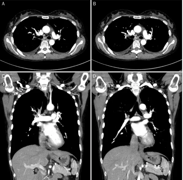 Fig. 4. Follow up chest computed tomography after 2 months of rivaroxaban treatment. The previously noted filling defect in the lobar and segmen- segmen-tal branches of the right pulmonary artery had disappeared