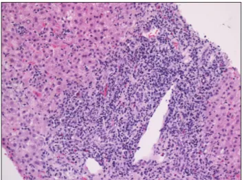 Fig. 2. Microscopic finding of liver needle biopsy. The picture shows  many lymphocytes infiltration (H&amp;E, ×200)