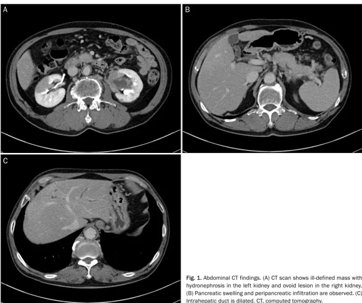 Fig. 1. Abdominal CT findings. (A) CT scan shows ill-defined mass with  hydronephrosis in the left kidney and ovoid lesion in the right kidney