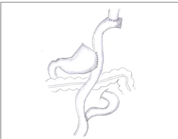 Fig. 3. Direct esophago-gastrostomy after laparoscopic proximal gas-  trectomy.