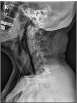 Fig. 4. Colonocopic finding. (A) The perforation was found at the rectosigmoid colon. (B) Endoscopic clipping was performed to close the  perforation.