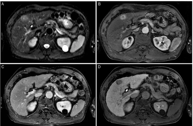 Fig. 2. Liver magnetic resonance images (MRI). (A) MRIs show a nodule with central scar showing high signal intensity on T2 weighted image