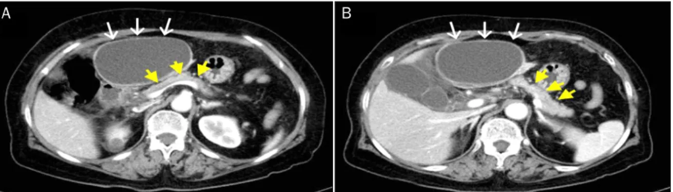 Fig. 2. (A) Follow-up abdominal computed tomography scan demonstrated a huge cystic mass arising from left lateral section of the liver
