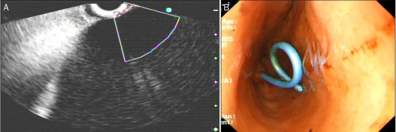 Fig. 3. (A) Endoscopic ultrasonography revealed a huge hypoechoic lesion with internal echogenicity without any solid components or mural  nodes