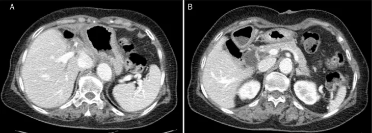 Fig. 6. Abdominal computed tomography after 28 months of operation. There were no abnormal findings of the liver (A) and pancreas (B)