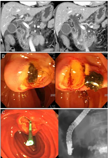 Fig. 1. Representative images. (A) A bile duct stone was impacted  in the ampulla of vater and swollen of pancreas with multiple fluid  collections was noticed on computed tomography