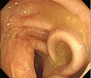 Fig. 1. Colonoscopic view of Ascaris lumbricoides that was found in the descending colon.