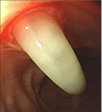 Fig. 4. Ascaris lumbricoides sticking out of the ampulla of Vater.