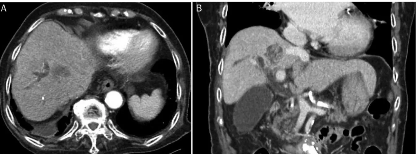 Fig. 1. Initial CT scan. (A, B) CT scan shows 2.8×2.6 cm ill-defined low attenuating lesion with peripheral enhancement at the liver segment  8 with dilation of the right intrahepatic duct