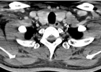 Fig. 4. Neck computed tomography showed multiple cervical lym- lym-phadenopathy (white arrow).