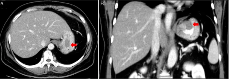 Fig. 1. Abdominal computed tomographic findings. (A, B) About 2.7 cm sized intraluminal polypoid mass at the gastric fundus (arrow).