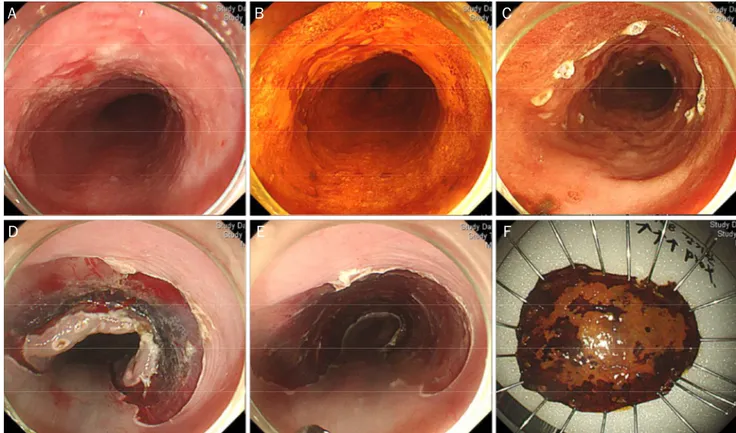 Fig. 1. Endoscopic submucosal dissection procedure. (A) On the lower thoracic esophagus, a 3-cm-sized geographic mucosal hyperemia with  uneven surface is noticed