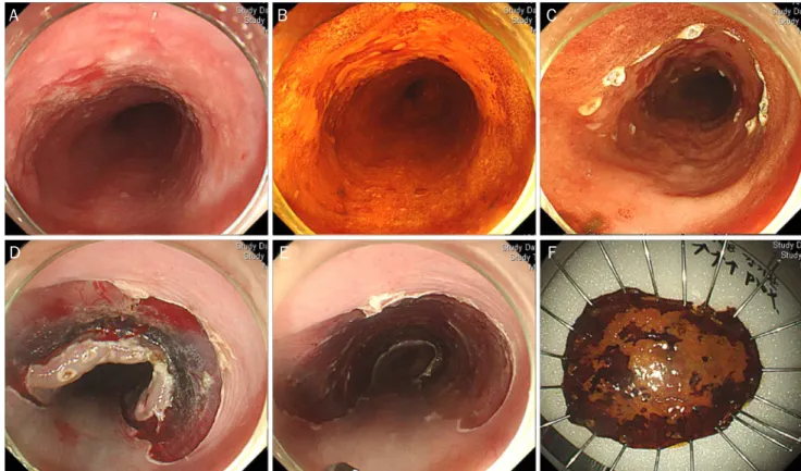 Fig. 1. Endoscopic submucosal dissection procedure. (A) On the lower thoracic esophagus, a 3-cm-sized geographic mucosal hyperemia with  uneven surface is noticed