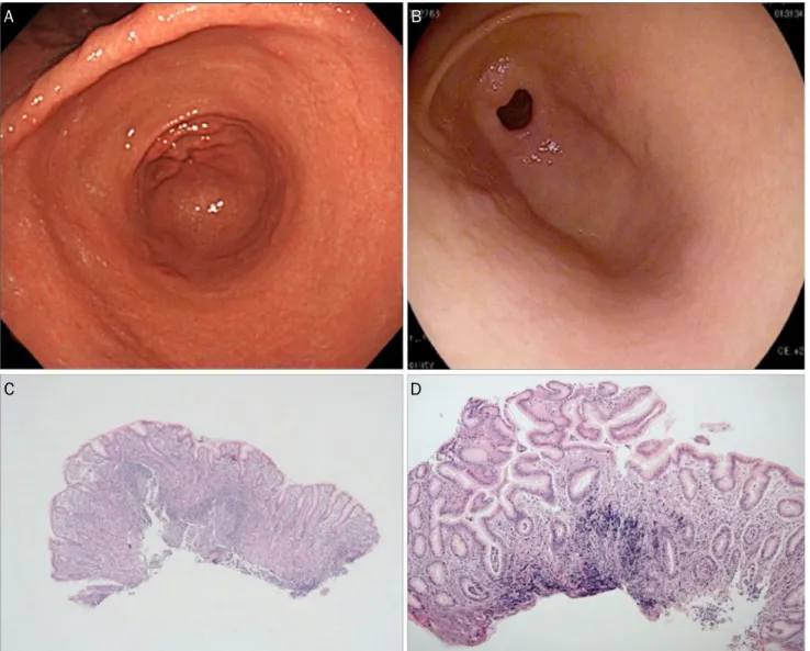 Fig. 2. Lymphoid cell aggregate-dominant type. (A) The endoscopic findings of the antrum are consistent with nodular gastritis of the  small-granular type