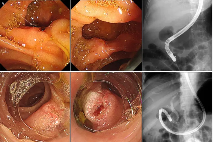 Fig. 1. Biliary cannulation with cap-fitted forward-viewing endoscope in patients with periampullary diverticulum