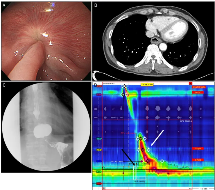 Fig. 1. The initial examination findings. (A) The initial upper endoscopy shows a contracted esophagogastric junction