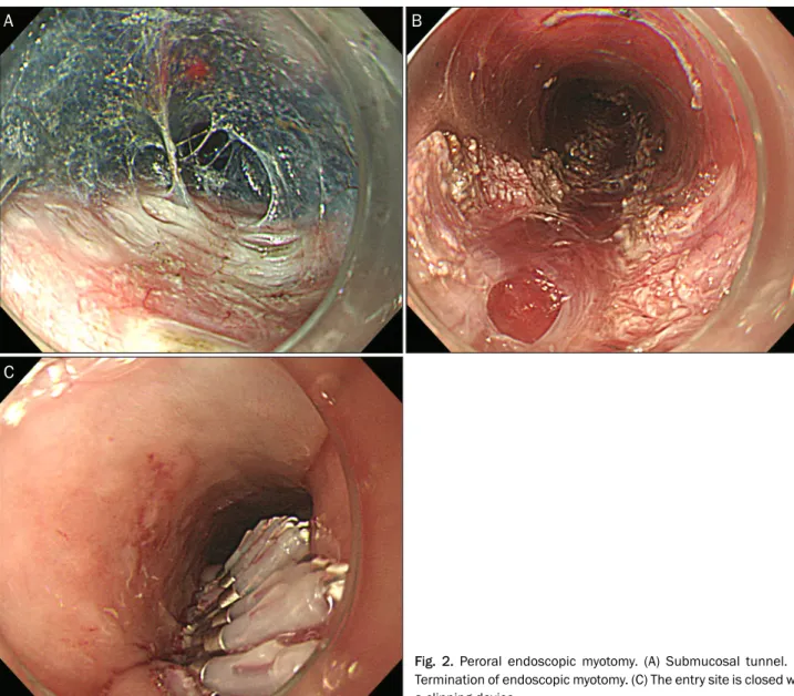 Fig. 2. Peroral endoscopic myotomy. (A) Submucosal tunnel. (B)  Termination of endoscopic myotomy