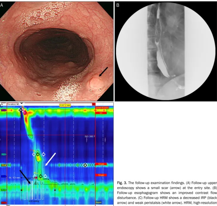 Fig. 3. The follow-up examination findings. (A) Follow-up upper  endoscopy shows a small scar (arrow) at the entry site