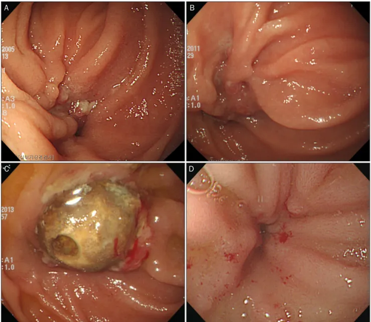 Fig. 1. Serial endoscopic findings. (A) At endoscopy 8 years ago, a shallow ulcerative lesion with nodular change and convergence of mucosal  folds is observed at the second portion of the duodenum