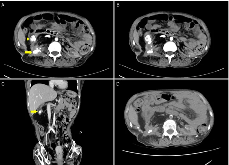 Fig. 2. Abdominal computed tomography. (A) In the right kidney, parenchymal calcification and staghorn calculi (arrow) are observed