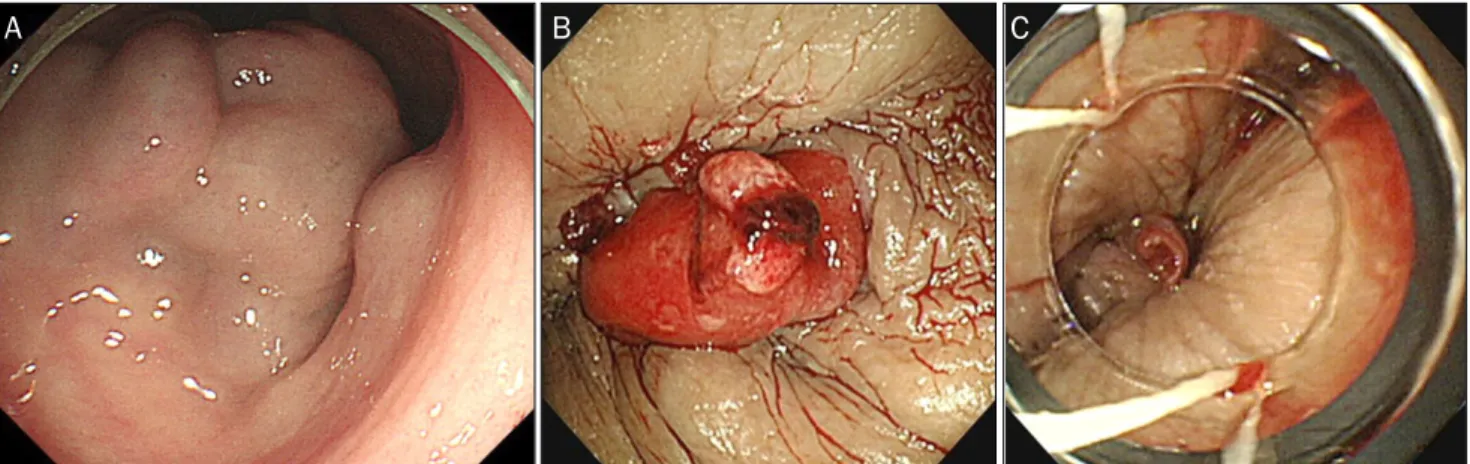 Fig. 1. Sigmoidoscopic finding. Huge anorectal varices (A) and stigmata of recent hemorrhage near the dentate line (B)