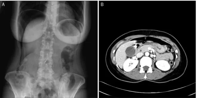 Fig. 2. (A) Abdominal X-ray after endoscopic resection showing bilateral sub-diaphragmatic free air