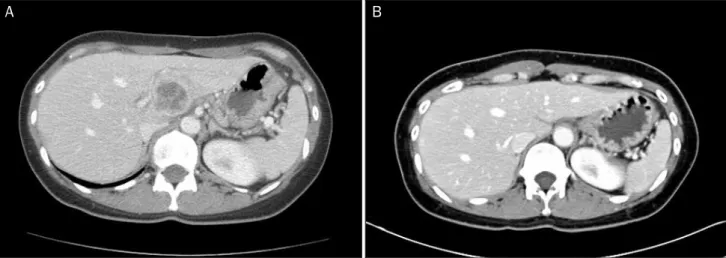 Fig. 3. (A) Liver abscess with a size of 7.5×7.0 cm is observed in the segment three on the abdominal computed tomography