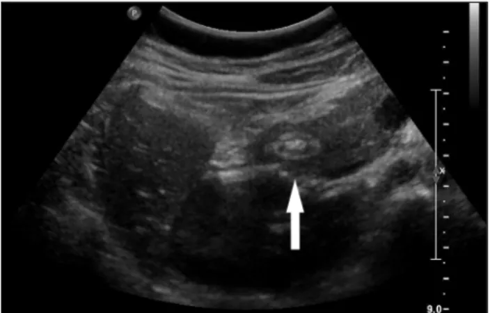 Fig. 2. Upper abdominal sonography showed second portion of  duodenum within pancreatic parenchyme (white arrow)