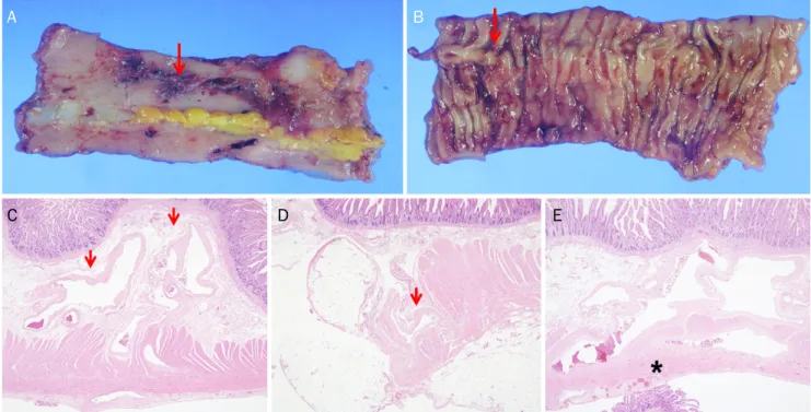 Fig. 3. Abdominal computed tomography revealed venous dilatation on the ileum (red arrows) adjacent to the uterus.