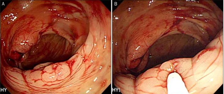 Fig. 1. At proximal ascending colon, there was dilated vascular structure with shallow erosion (A)