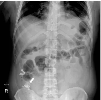 Fig. 3. Simple abdomen after 2nd endoscopic variceal obturation  (white arrow: lipiodol in the ascending colon varix).