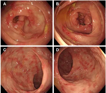 Fig. 1. Colonoscopic finding of a patient with eosinophilic colitis  showing non-specific inflammatory changes, mucosal edema,  patchy eythema, and loss of vascularity