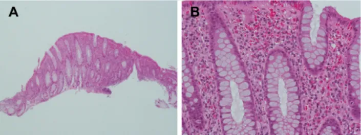 Fig. 3. Follow up sigmoidoscopy. Non-specific inflammatory mucosal lesion was improved compared with previous sigmoidoscopy