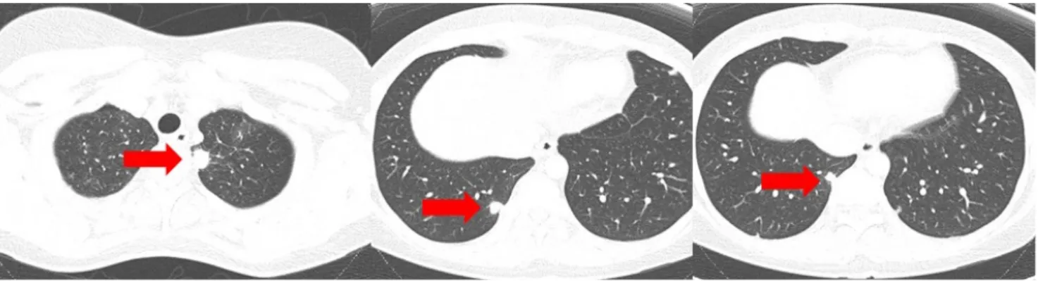 Fig. 2. Colonoscopy findings showing multiple various sized  longitudinal ulcers and perianal ulcers with edematous changes.