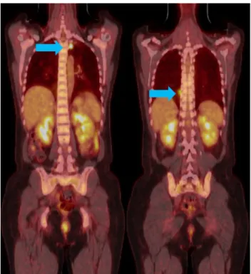 Fig. 3. PET-CT showed multiple various sized ill-defined pulmonary  nodules (arrows) with highly increased 18F-FDG uptake (pSUV  3.67-8.88)