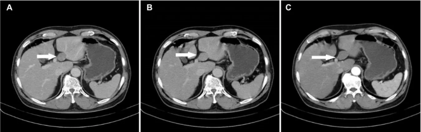 Fig. 2. Dynamic abdominal computed tomography (CT). (A) Arterial phase (arrow), (B) portal phase (arrow), (C) venous phase: CT showed a well-defined, rounded (arrow), low-attenuating mass with homogeneous attenuation in the left lobe of the liver.