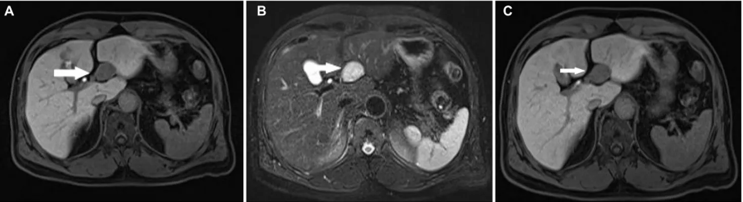 Fig. 3. Liver magnetic resonance imaging. (A) T1-WI. A 35 mm suspicious enhancing lesion (white arrow) in the left liver: a mass that is mildly hypointense or isointense on non-contrasted T1-WI