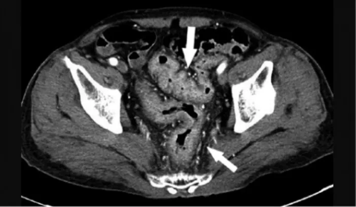 Fig. 3. Rectum biopsy showed lymphoplasmacytic infiltration,  ulceration, and a few distorted crypts (H&amp;E, ×10).