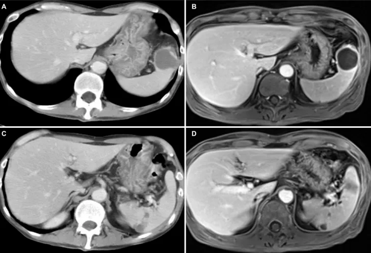 Fig. 1. APCT and MRI showed that 3.5 cm well-capsulized cystic lesion with internal debris in the spleen (A, B) and multifocal lenticular shaped  and cystic changes in the periphery of the spleen (C, D)
