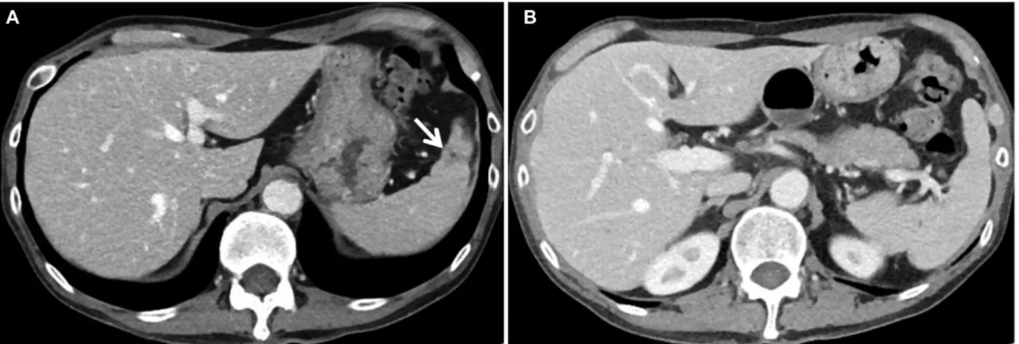 Fig. 2. APCT after one month's treatment showed nearly complete resolution of previous 3.6 cm cystic lesion in the spleen anterior pole, except a tiny 3 mm sized remnant hypodense lesion (A, arrow) and complete disappearance of peripherally multi-located l